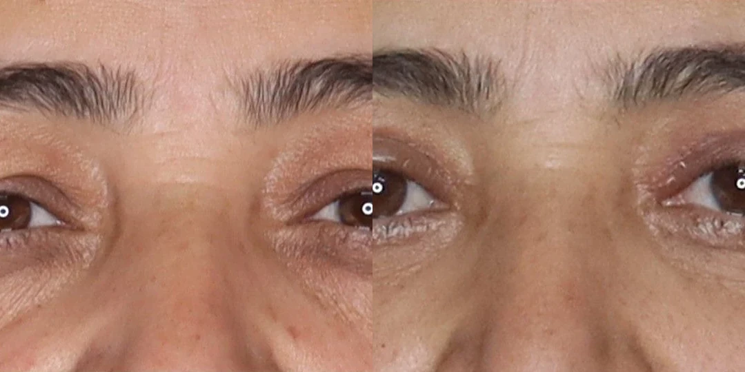 Resultado real de efeito blefaroplastia com CO₂, comparativo de antes e depois