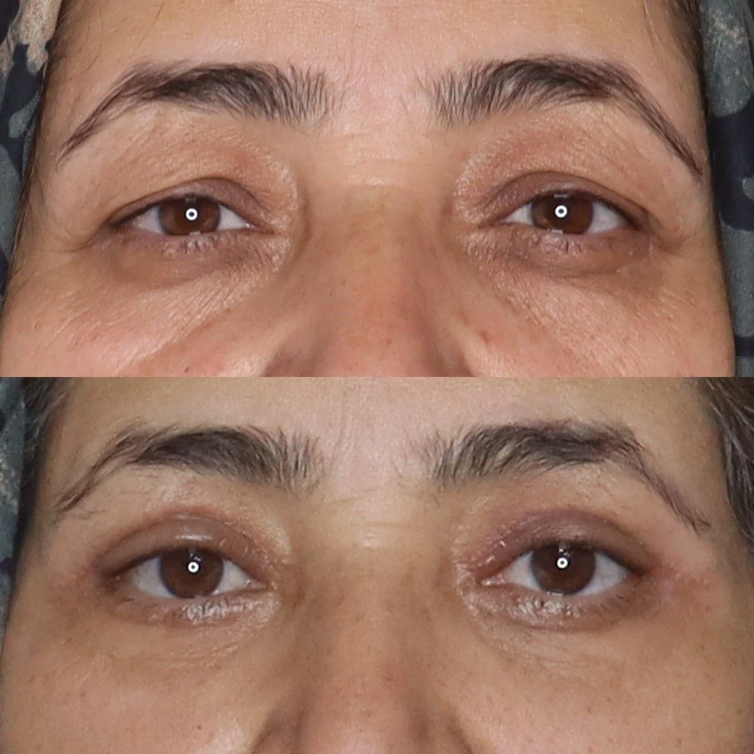 Resultado real de paciente no tratamento Efeito blefaroplastia com CO₂