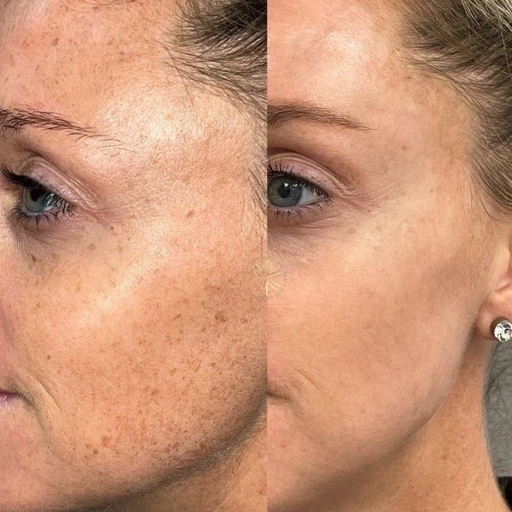 Resultado real de paciente no tratamento Laser Lavieen